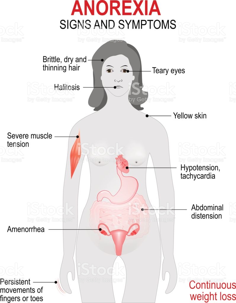 Pregnancy and Neonatal Characteristics for Women With Anorexia Nervosa